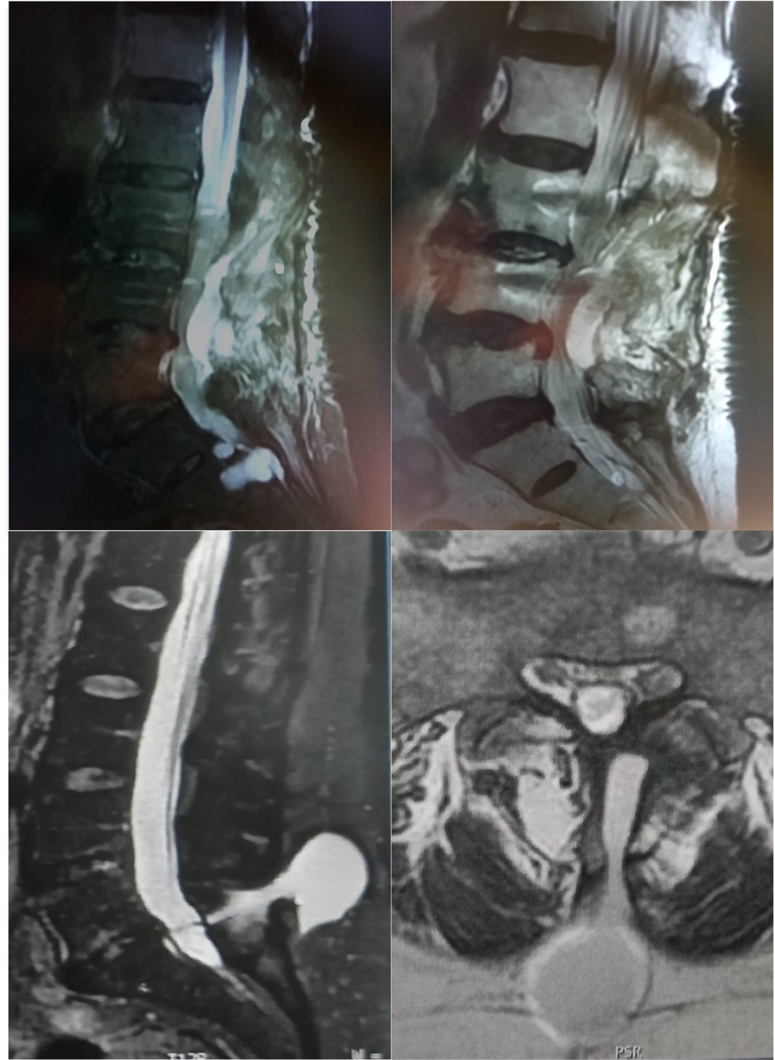Tortuga mensual La forma Complicaciones en la cirugía de hernia discal lumbar. Parte 1